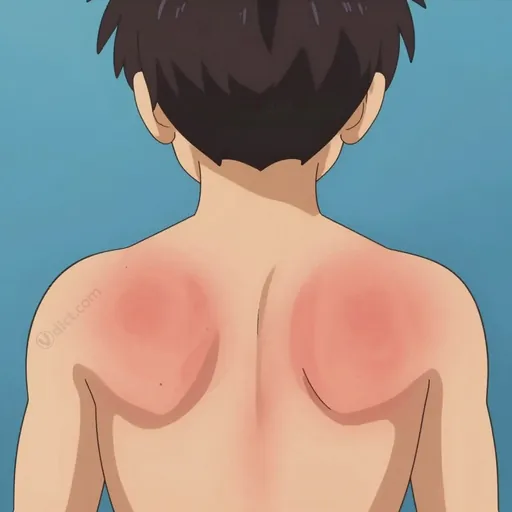 shingles
