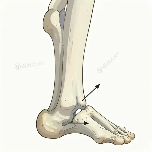 exostose